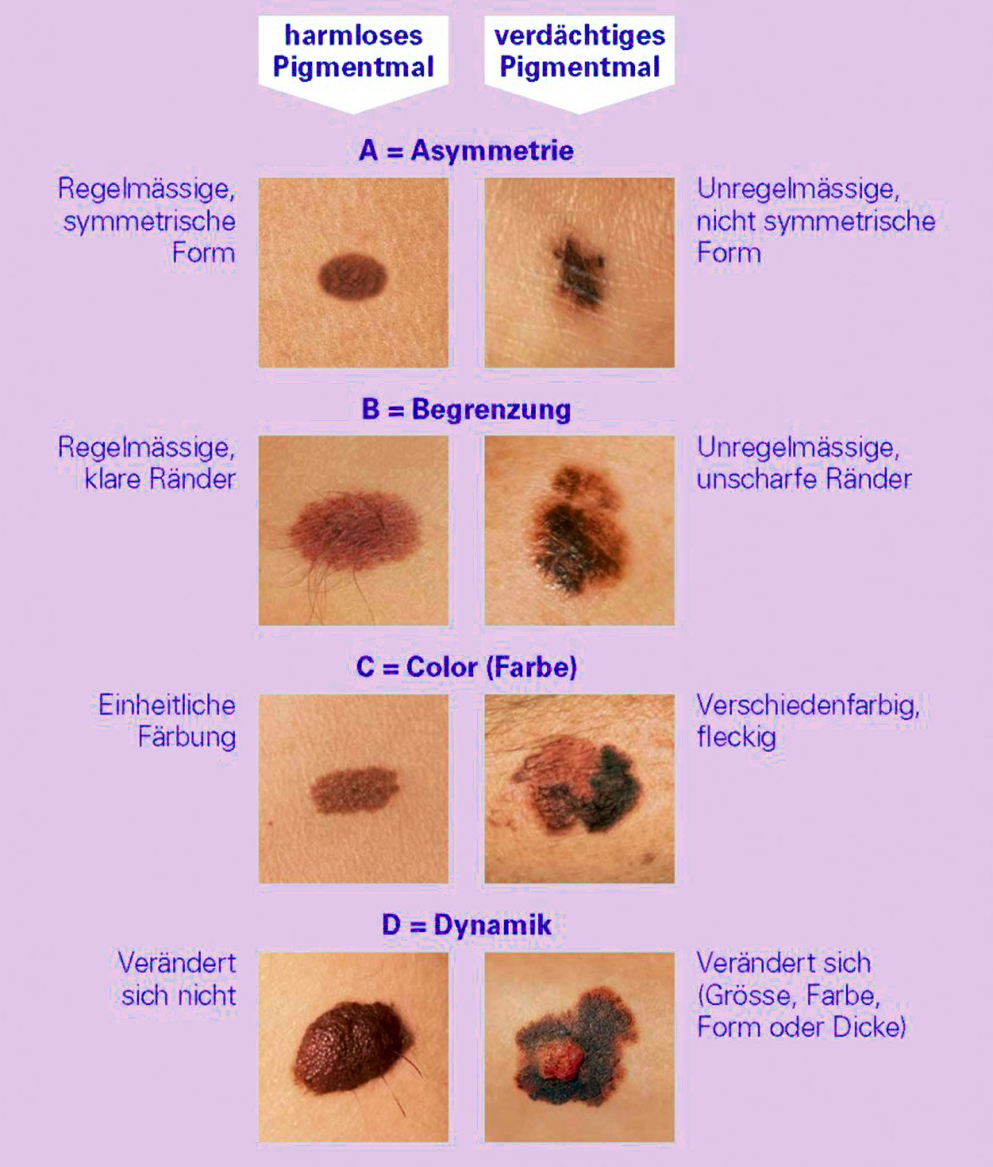 Abcd regel 4 1 
