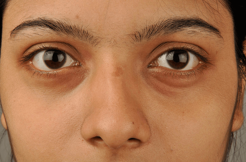 augenringe